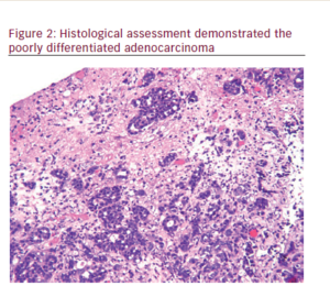 Asymptomatic Metastatic Esophageal Cancer Presenting Like Stroke—A Case ...