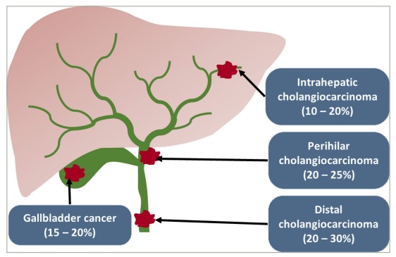 Figure 1: A diagram showing the anatomical locations of the different subtypes of biliary tract cancer and the approximate total percentage of incidence of each subtype out of all biliary tract cancers. Extrahepatic cholangiocarcinoma includes both perihilar and distal cholangiocarcinoma.