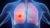 3d medical illustration of lung cancer
