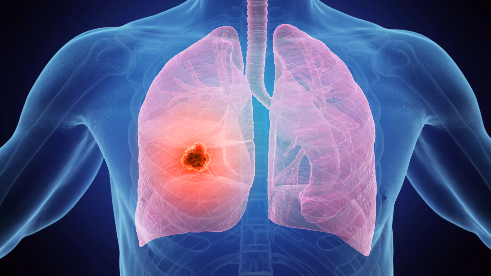 3d medical illustration of lung cancer