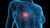 Comprehensive Anatomical Render Of Breast Cancer In A Human Female