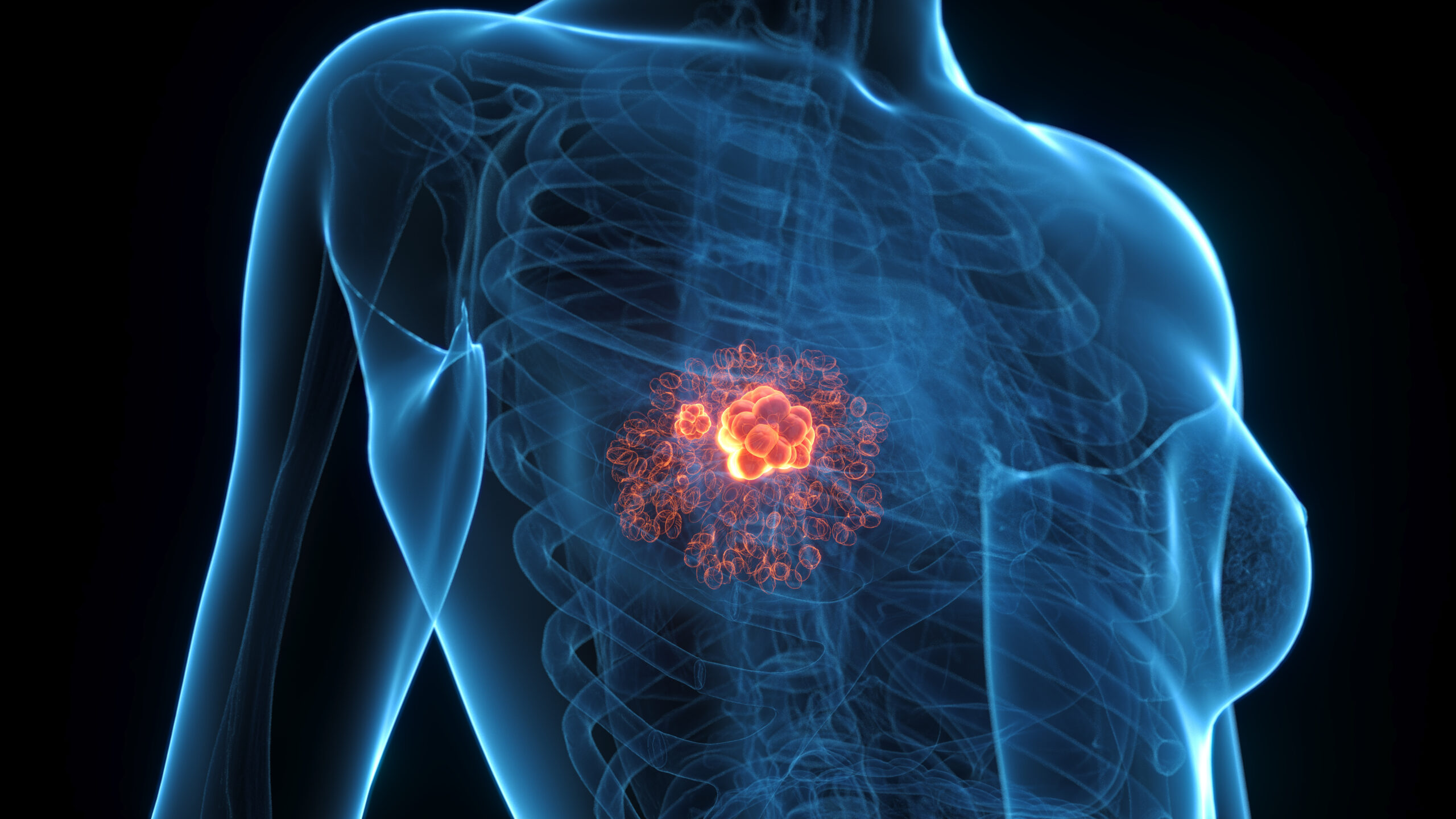 Comprehensive Anatomical Render Of Breast Cancer In A Human Female