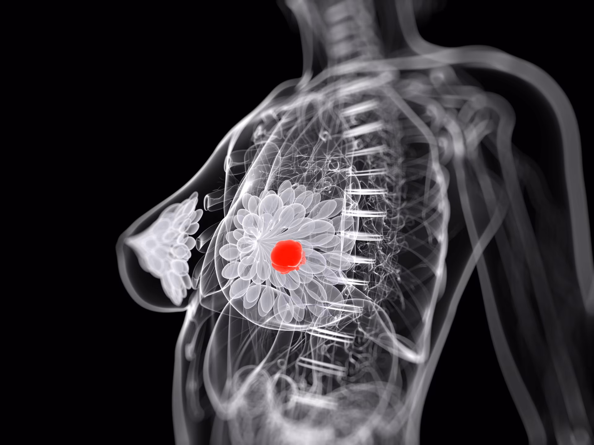 3d rendered medical illustration of breast cancer